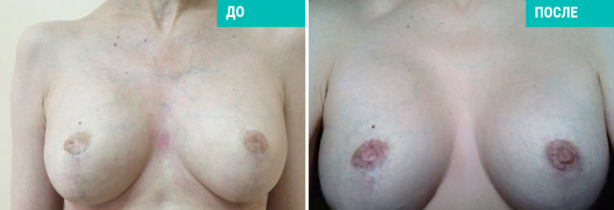 Втянутые соски