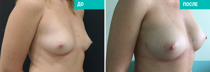 Липофилинг груди