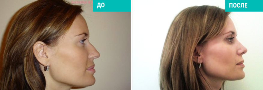 Ринопластика