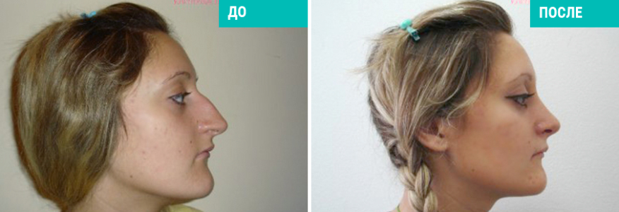 Ринопластика