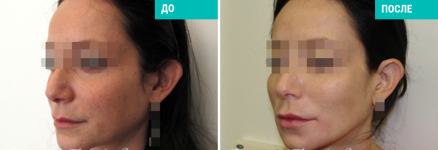 Софтлифтинг - безоперационная подтяжка лица