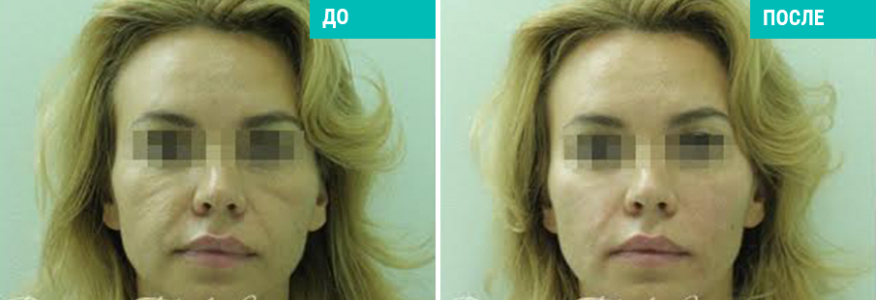 Софтлифтинг