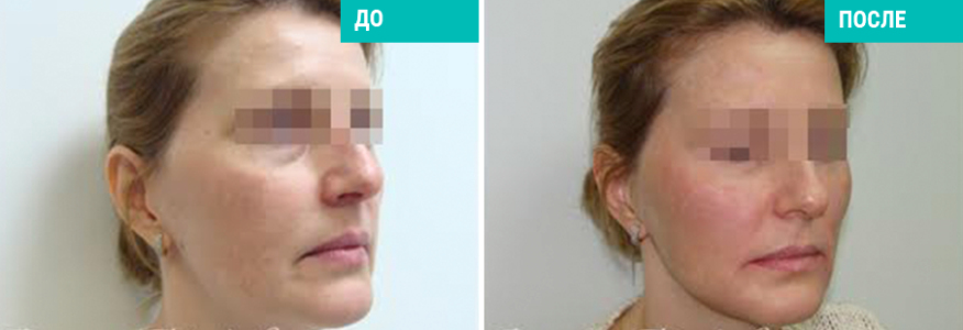 Софтлифтинг