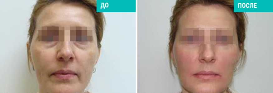 Софтлифтинг