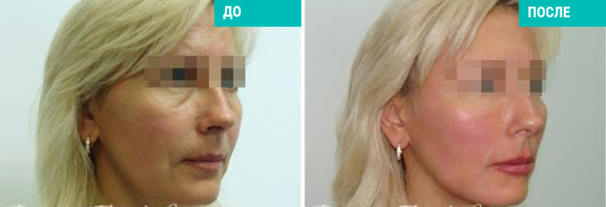 Софтлифтинг