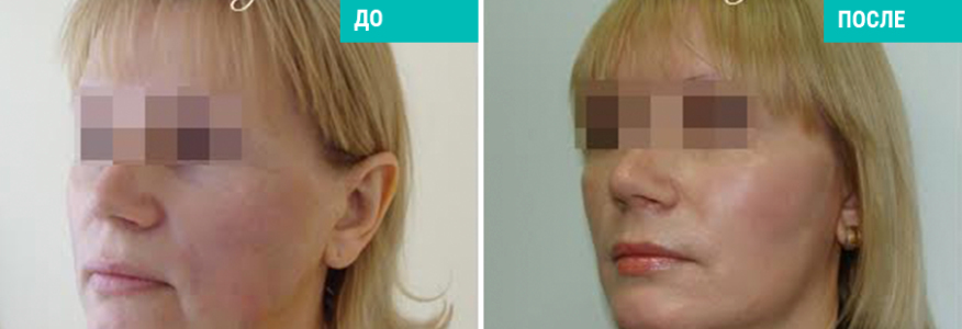 Подтяжка нитями Силуэт-Лифт 