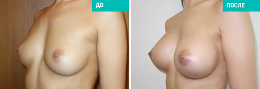 Увеличение груди