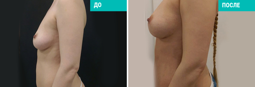 Липофилинг груди