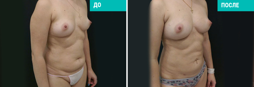 Липофилинг груди