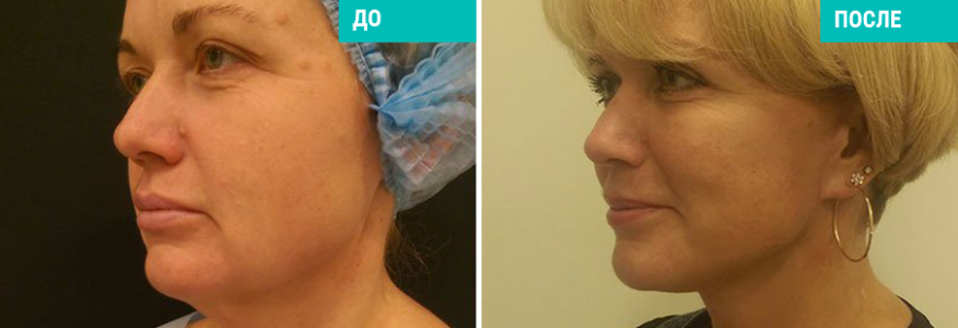 Васер моделирование лица