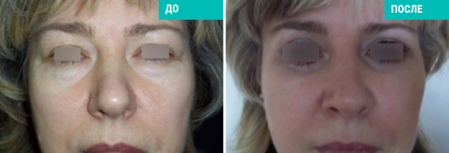 Блефаропластика 