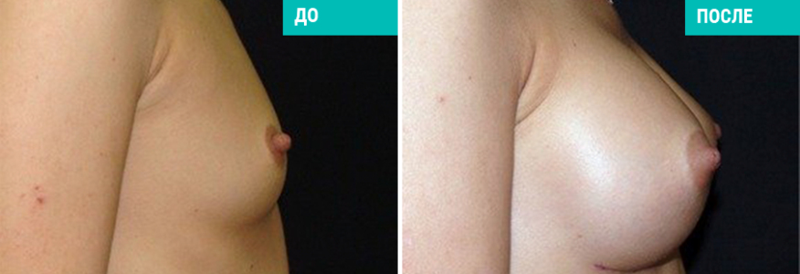 Увеличение груди