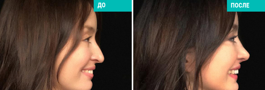 Ринопластика