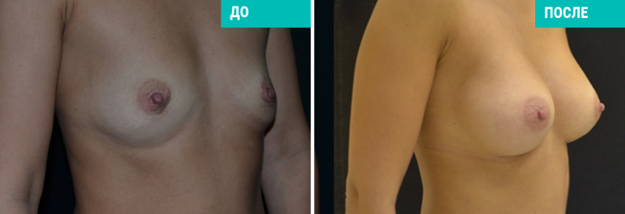 Увеличение груди
