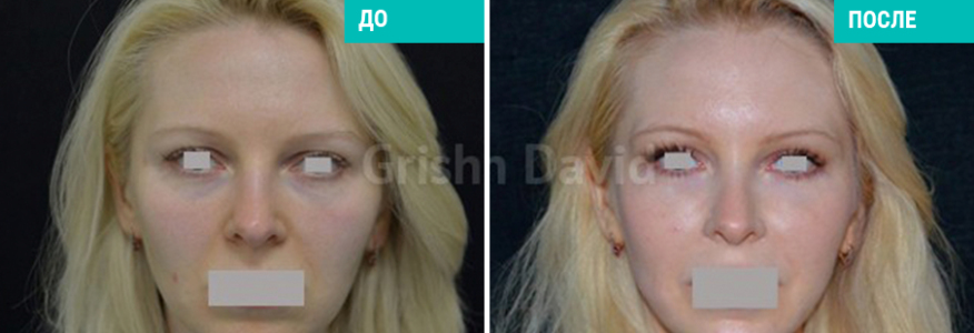 Липофилинг лица