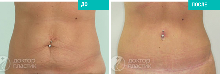 Подтяжка живота