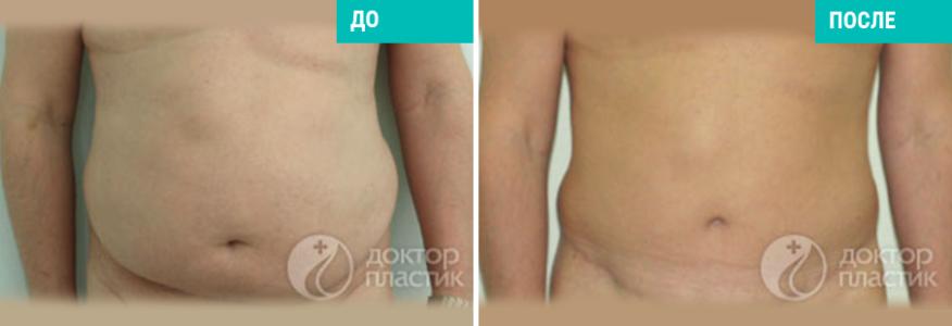 Подтяжка живота