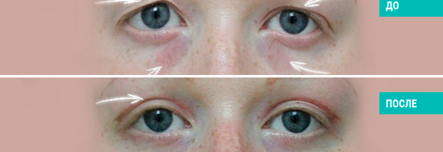 Блефаропластика