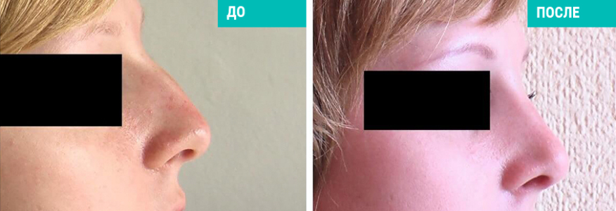 Ринопластика