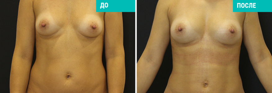 Увеличение груди