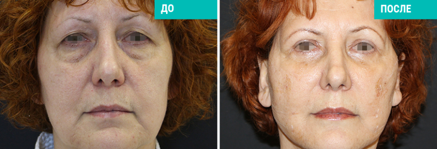 Пластика лица