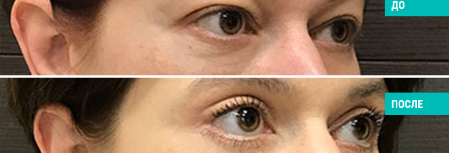 Блефаропластика