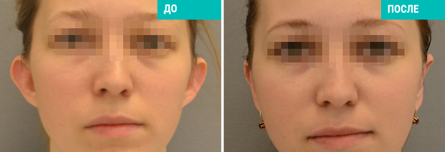 Отопластика