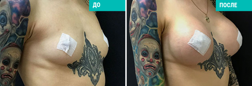 Увеличение груди