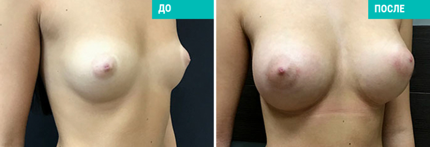 Увеличение груди