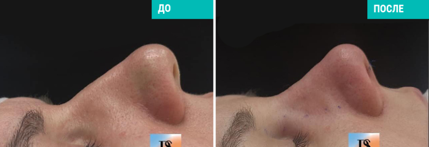 Ринопластика