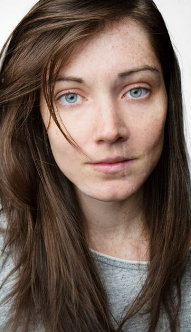 Вопрос-ответ: лазерная шлифовка рубцов и шрамов