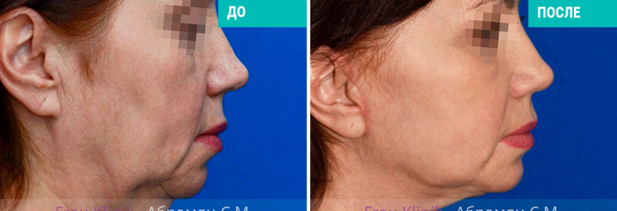 Фейслифтинг