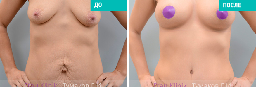 Пластика живота + грудь