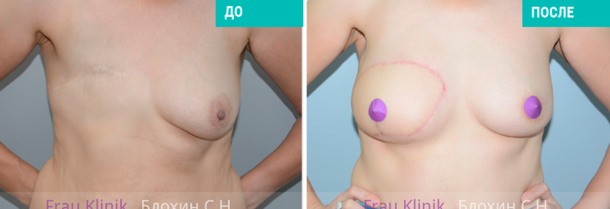 Восстановление груди после рака