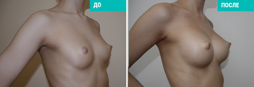 Увеличение груди
