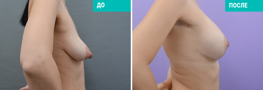 Подтяжка груди