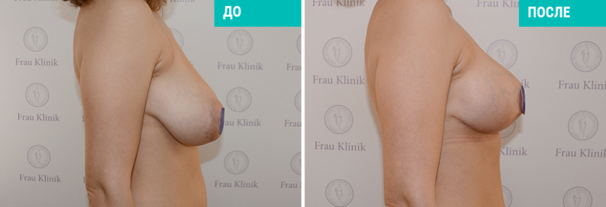 Подтяжка груди