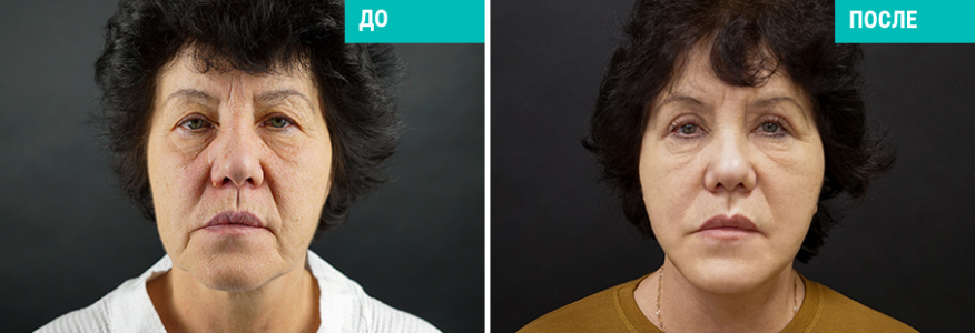 Фейслифтинг