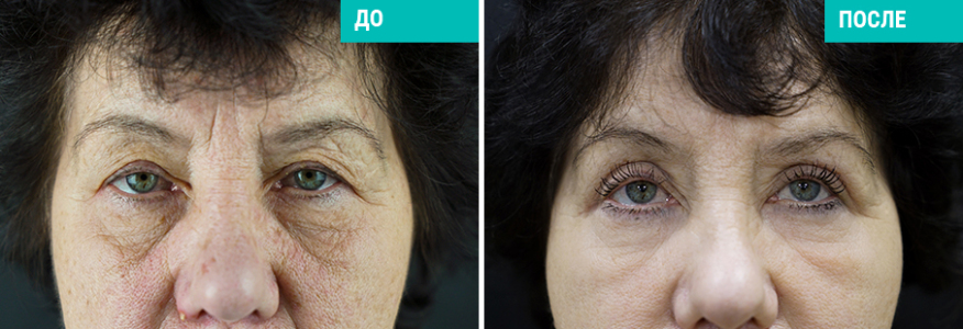 Фейслифтинг