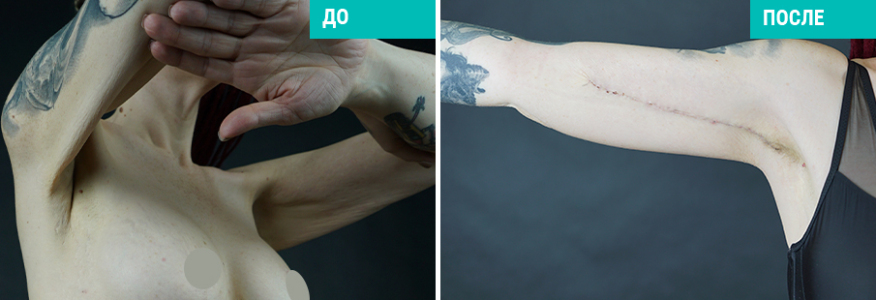 Абдоминопластика+брахиопластика