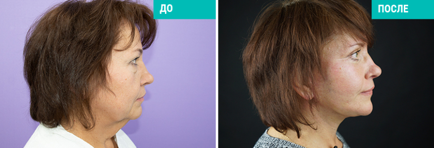 Фейслифтинг