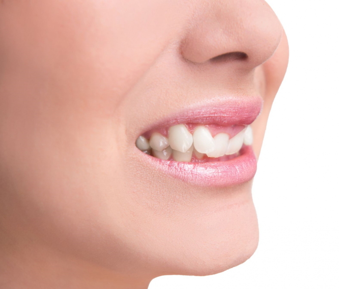 Операция по исправлению прикуса