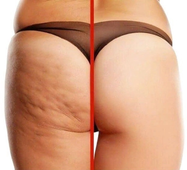 Как избавиться от целлюлита?