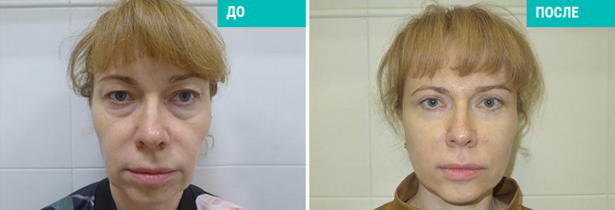 Смас подтяжка лица, подтяжка шеи и круговая блефаропластика.