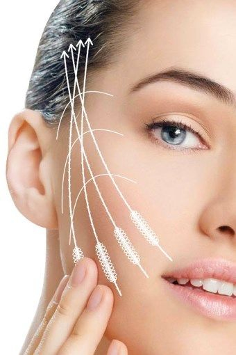 3-D мезонити: альтернатива пластике или маркетинговый ход?