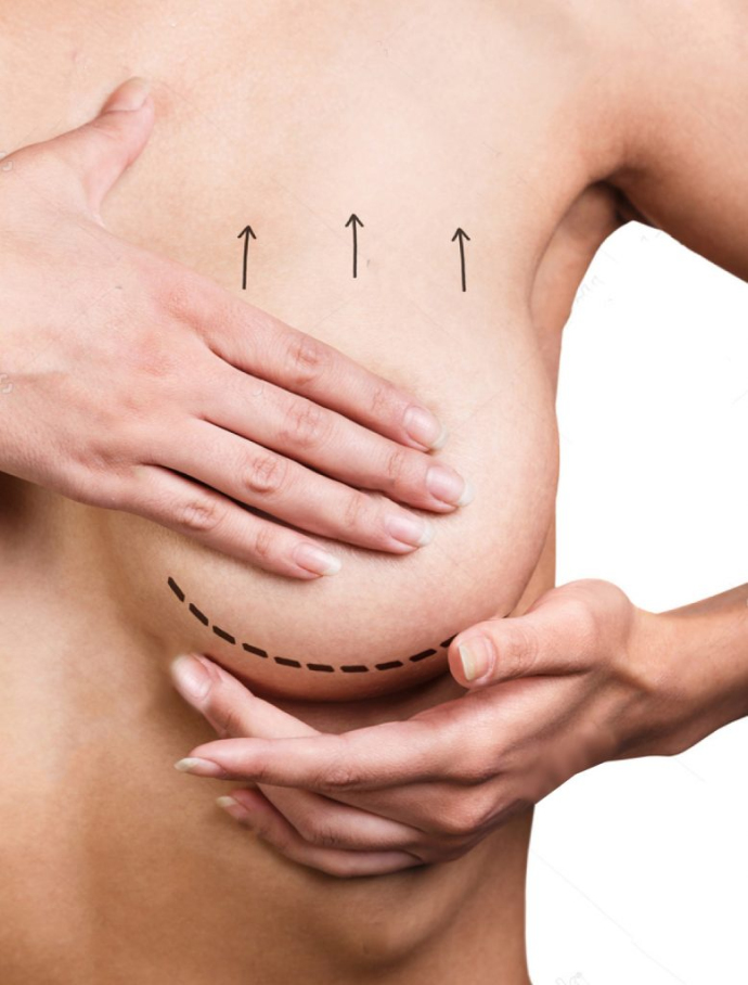 Подтяжка груди нитями: делать или нет?