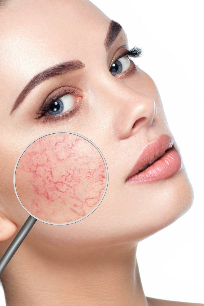Как удалить купероз: обзор методик