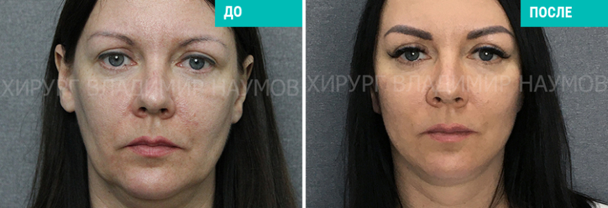 Спейслифтинг