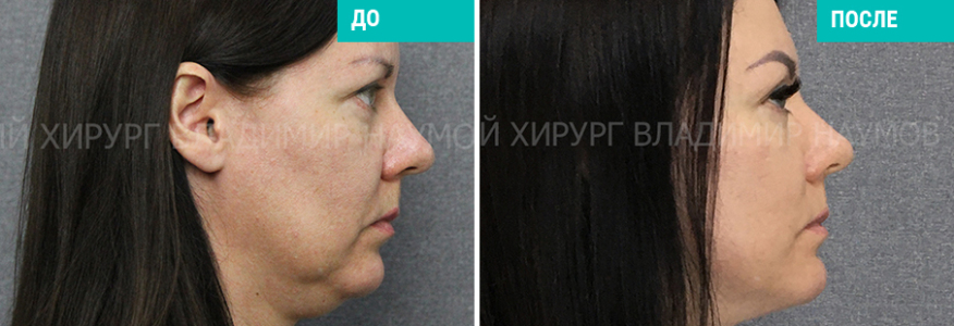 Спейслифтинг