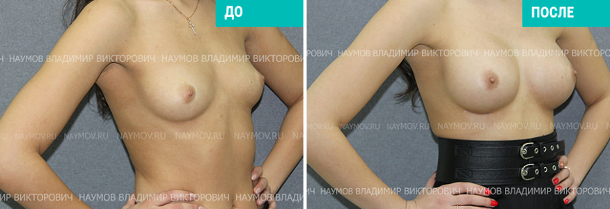 Увеличение груди